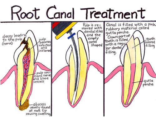 Root Canal Therapy