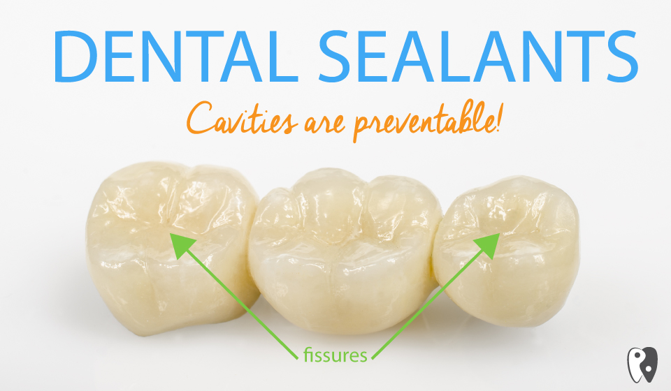 Dental sealants