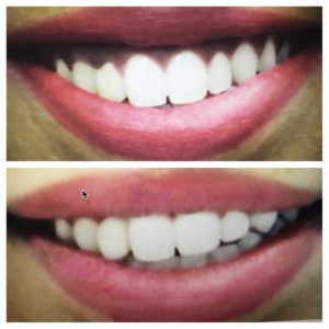 Lip Repositioning Treatment-How to Get Rid of a Gummy Smile-D. Dental