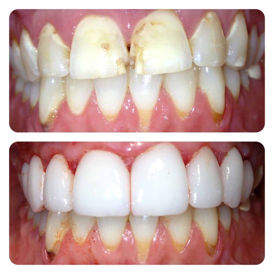 Cosmetic Dentistry Before and After Photos