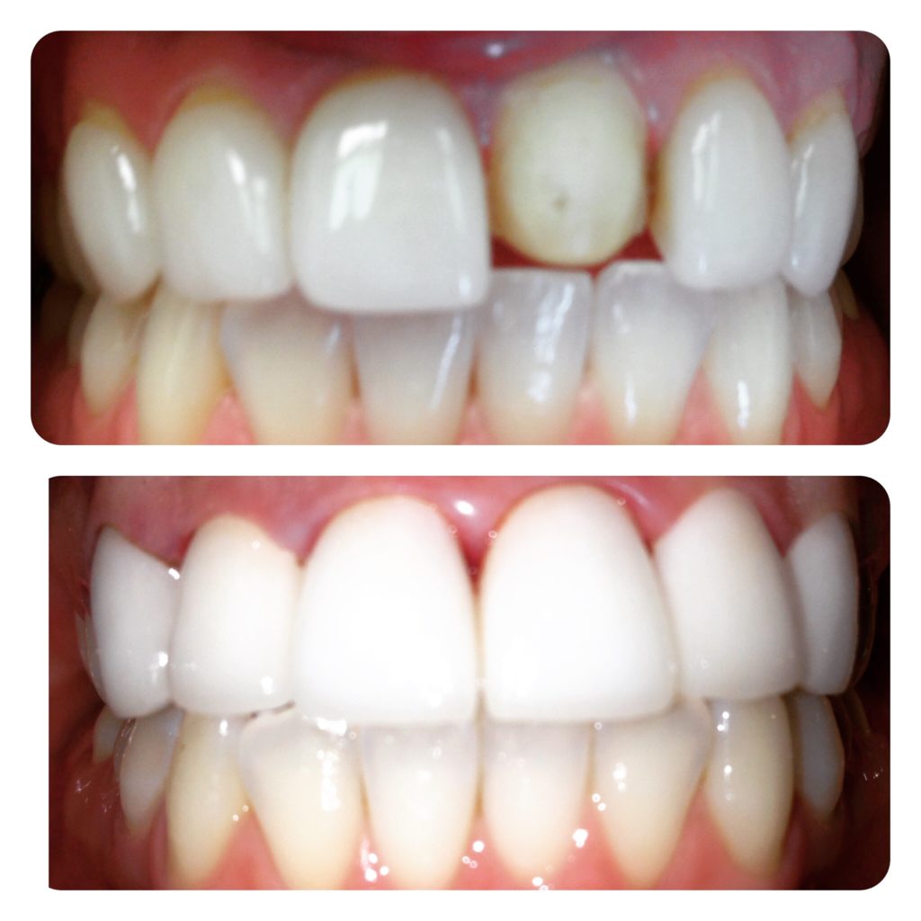 zoom teeth whitening dallas