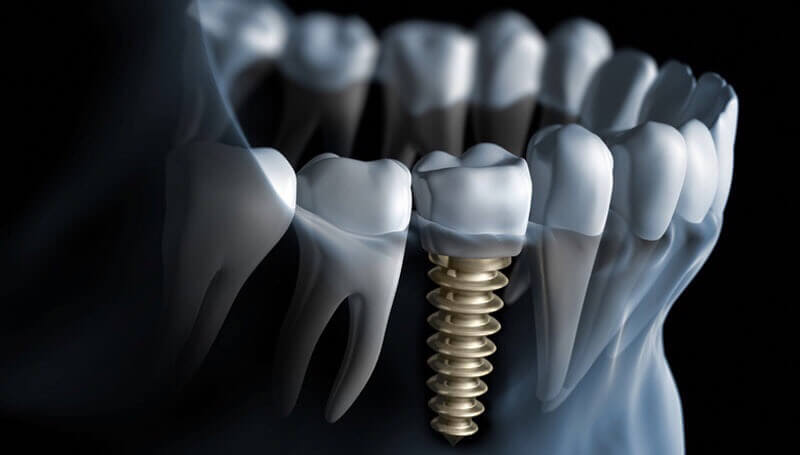 castle-hills-best-dentist-dental-implants