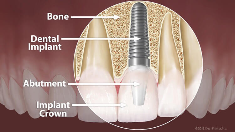 castle-hills-dentist-implant