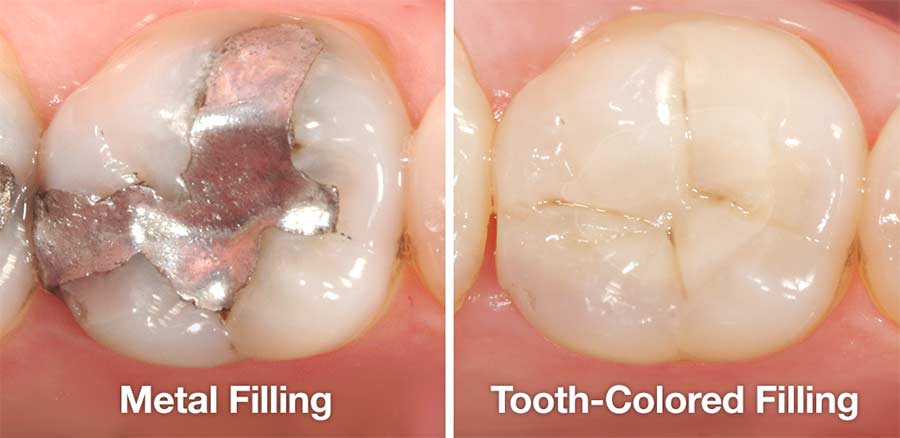 Metal Vs Tooth Colored Fillings D Dental