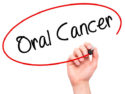 How Does Oral Cancer Start? Where Do Most Oral Cancers Occur? - D. Dental